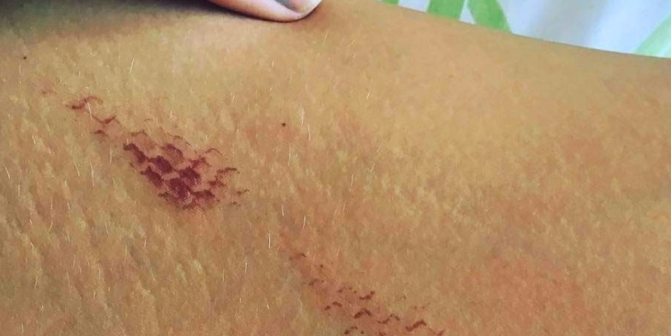 Image showing skin damage from a NOS cracker burn