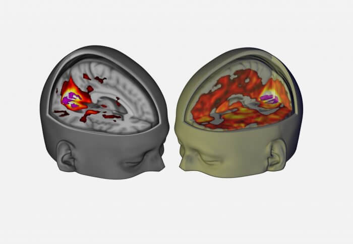 Brain scan of someone after they've taken LSD and someone who hasn't. The brain of the person that took the LSD shows a lot more activity than the one that hasn't