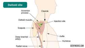 Injection site in the upper arm